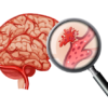 Hemorrhagic strokes