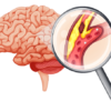 Transient Ischemic Attack (TIA)