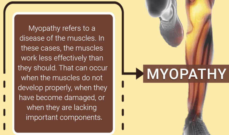 Myopathy Treatment By Specialist